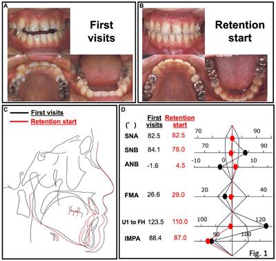 Case report: Long-term management of occlusion after surgical-orthodontic treatment for a patient with drug-induced open bite developed after the onset of schizophrenia